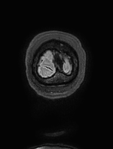 Cavernous hemangioma of the cerebellar falx (Radiopaedia 73025-83724 Coronal FLAIR 350).jpg