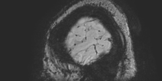 Cavernous hemangioma of the cerebellar falx (Radiopaedia 73025-83724 Sagittal BOLD 12).jpg