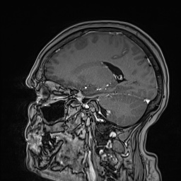 Cavernous sinus meningioma (Radiopaedia 63682-72367 Sagittal T1 C+ 108).jpg