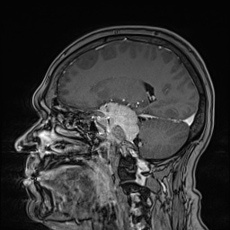 Cavernous sinus meningioma (Radiopaedia 63682-72367 Sagittal T1 C+ 76).jpg