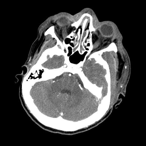 File:Cavernous sinus thrombosis (Radiopaedia 10619-11078 A 5).jpg