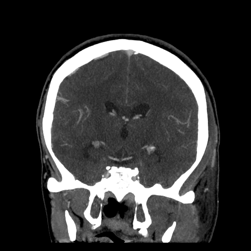 File:Cavernous sinus thrombosis (Radiopaedia 10619-11078 D 15).jpg