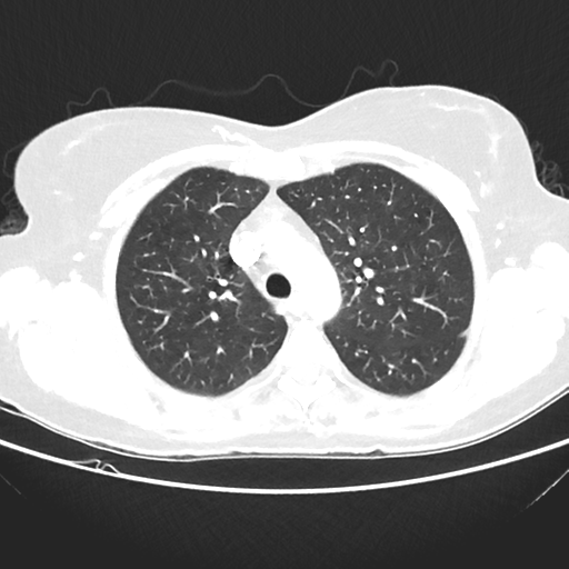 File:Cavitating lung mass - squamous cell carcinoma (Radiopaedia 48047-52854 Axial lung window 16).png