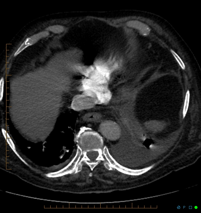 Cavitating pulmonary infarction (Radiopaedia 54634-60849 Axial C+ CTPA 67).jpg