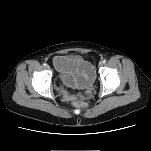 Cecal adenocarcinoma (Radiopaedia 75909-87331 A 80).jpg