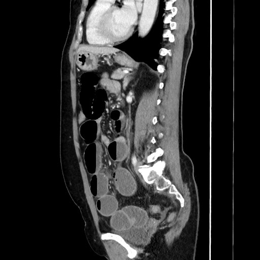 Cecal adenocarcinoma (Radiopaedia 75909-87331 C 44).jpg