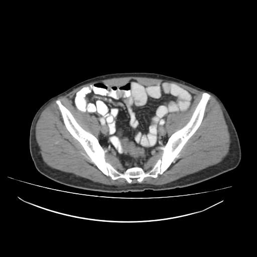 Cecal carcinoma with local lymphadenopathy (Radiopaedia 31428-32240 A 43).jpg