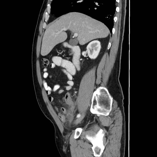 Cecal mass causing appendicitis (Radiopaedia 59207-66531 C 22).jpg