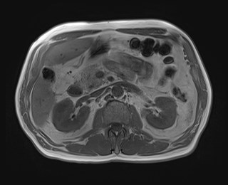 Cecal mass causing appendicitis (Radiopaedia 59207-66532 Axial T1 in-phase 54).jpg