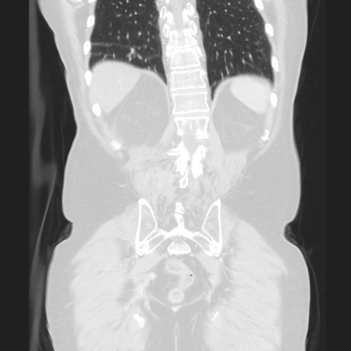 Cecal volvulus (Radiopaedia 75378-86620 Coronal lung window 109).jpg