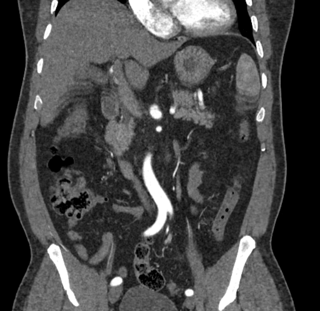 Celiac artery dissection (Radiopaedia 52194-58080 C 44).jpg