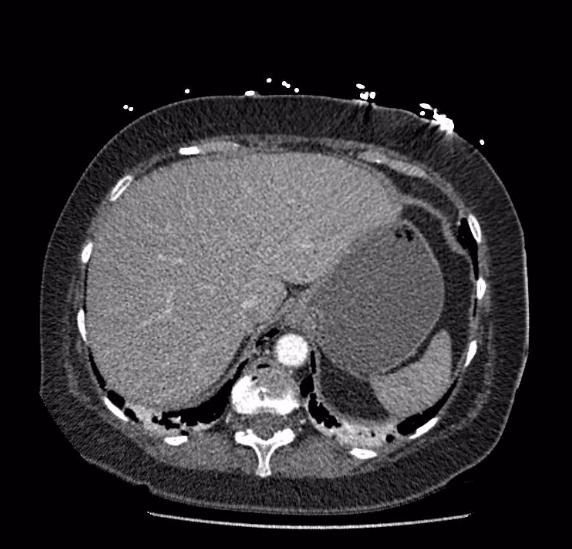 Celiac artery severe stenosis and dissection (Radiopaedia 44128-47842 B 10).jpg