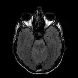 File:Central-variant posterior reversible encephalopathy syndrome (PRES) (Radiopaedia 43880-47358 Axial FLAIR 7).jpg