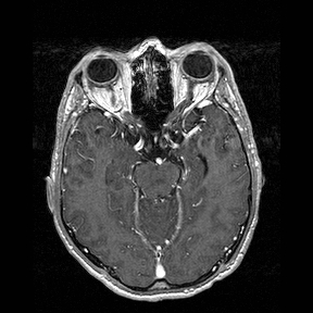 Central-variant posterior reversible encephalopathy syndrome (PRES) (Radiopaedia 43880-47358 Axial T1 C+ 58).jpg