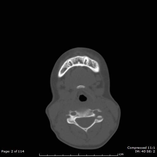 File:Central giant cell granuloma (Radiopaedia 45612-49754 Axial bone window 1).jpg