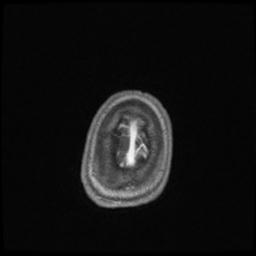 Central neurocytoma (Radiopaedia 30220-30842 Axial T1 C+ 144).jpg