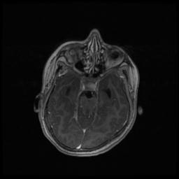 Central neurocytoma (Radiopaedia 30220-30842 Axial T1 C+ 51).jpg