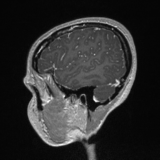 File:Central neurocytoma (Radiopaedia 37664-39557 Sagittal T1 C+ 19).png