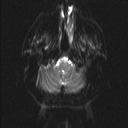 Central neurocytoma (Radiopaedia 56690-63469 Axial DWI 1).jpg