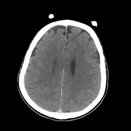 File:Central neurocytoma (Radiopaedia 68725-78432 Axial C+ 62).jpg