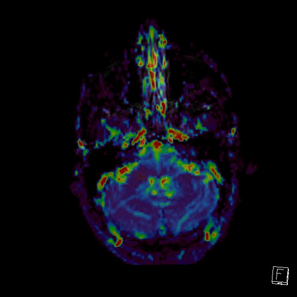 Central neurocytoma (Radiopaedia 84497-99872 Axial Perfusion 261).jpg