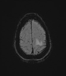 Central neurocytoma (Radiopaedia 84497-99872 Axial SWI 62).jpg