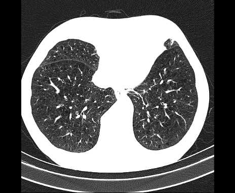 Centrilobular pulmonary emphysema (Radiopaedia 62468-70718 Axial lung window 58).jpg