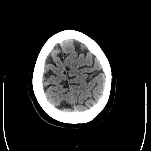 Cerebellar abscess (Radiopaedia 78135-90671 Axial non-contrast 93).jpg