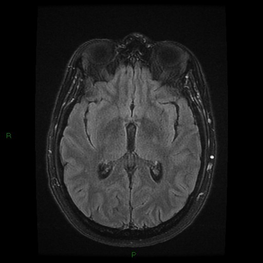 File:Cerebellar abscess (Radiopaedia 78135-90678 Axial FLAIR 16).jpg