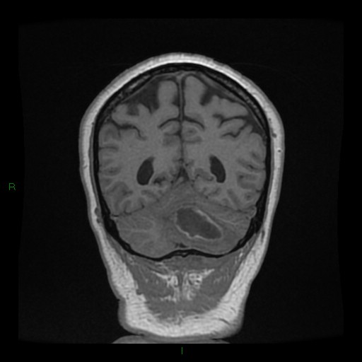 Cerebellar abscess (Radiopaedia 78135-90678 Coronal T1 C+ 125).jpg