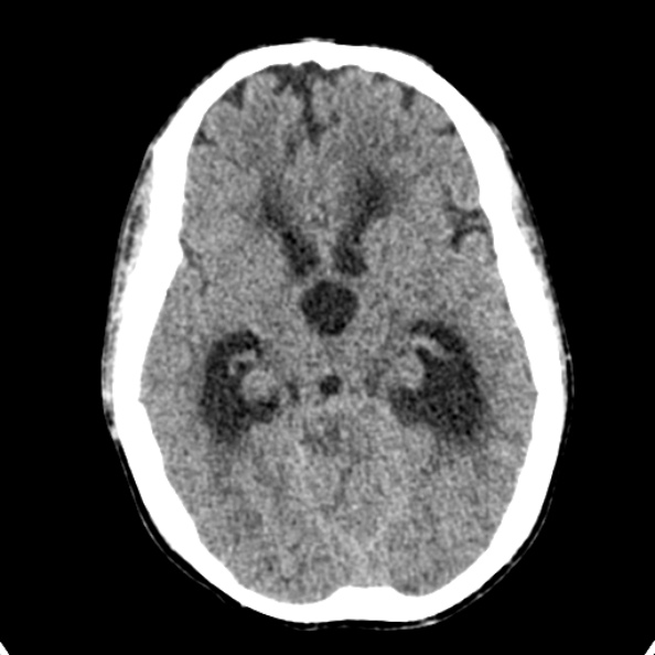 Cerebellar abscess secondary to mastoiditis (Radiopaedia 26284-26412 Axial non-contrast 66).jpg