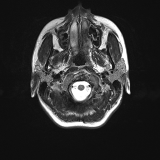 File:Cerebellar agenesis with hypoplastic pons (pontocerebellar hypoplasia) (Radiopaedia 57224-64138 Axial T2 4).png
