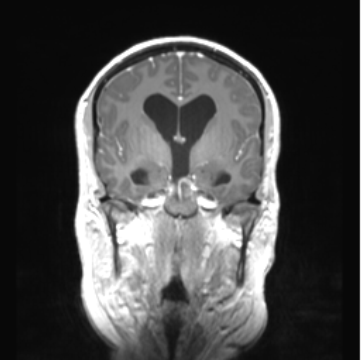 Cerebellar ependymoma complicated by post-operative subdural hematoma (Radiopaedia 83322-97736 Coronal T1 C+ 25).png