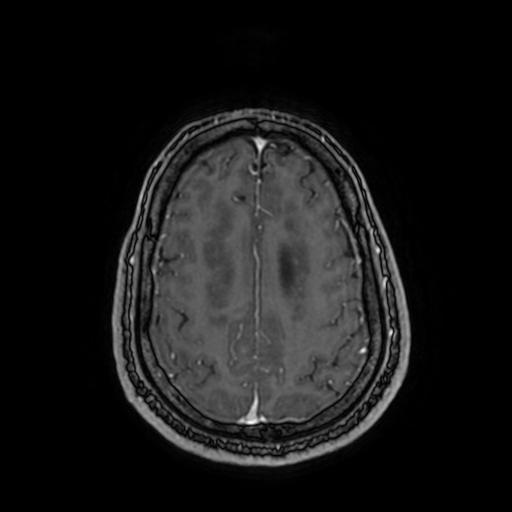 Cerebellar hemangioblastoma (Radiopaedia 88055-104622 Axial T1 C+ 135).jpg