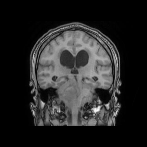 File:Cerebellar hemangioblastoma (Radiopaedia 88055-104622 Coronal T1 22).jpg