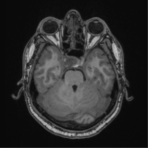 Cerebellar hemangioblastomas and pituitary adenoma (Radiopaedia 85490-101176 Axial T1 24).png
