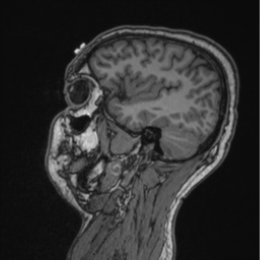 Cerebellar hemangioblastomas and pituitary adenoma (Radiopaedia 85490-101176 Sagittal T1 35).png