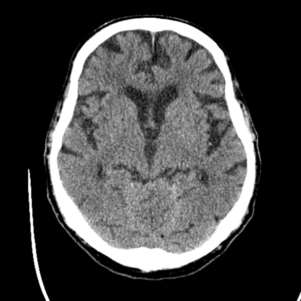 Cerebellar hemorrhage (Radiopaedia 27193-27359 Axial non-contrast 22).jpg