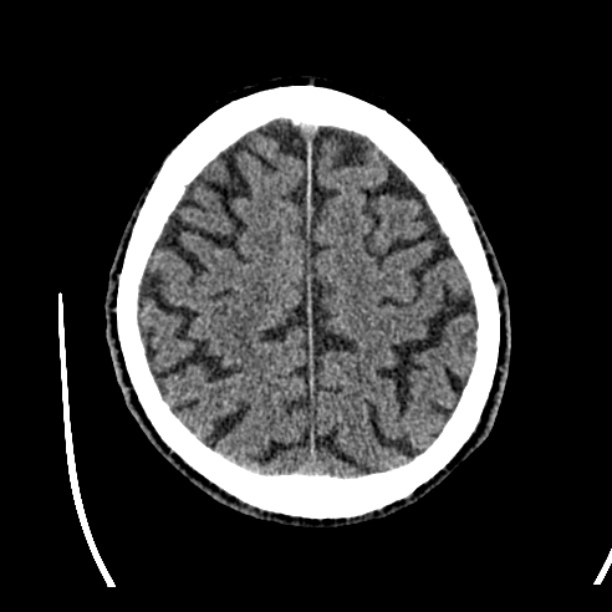 Cerebellar hemorrhage (Radiopaedia 27193-27359 Axial non-contrast 42).jpg