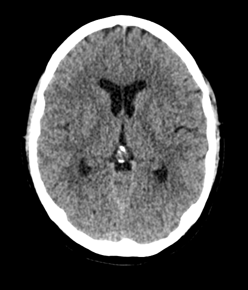 Cerebellar metastases - colorectal adenocarcinoma (Radiopaedia 40947-43652 Axial non-contrast 32).png