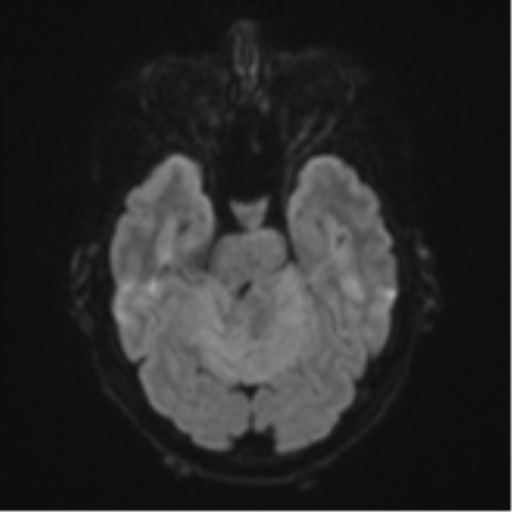 Cerebellar metastasis (Radiopaedia 51137-56765 Axial DWI 38).png
