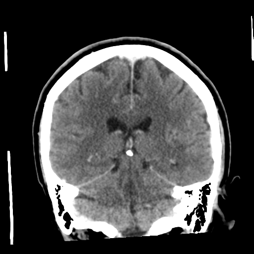 Cerebellar metastasis (cystic appearance) (Radiopaedia 41395-44258 D 39).png