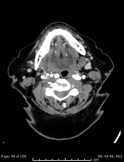 Cerebellar strokes due to intracranial giant cell arteritis (Radiopaedia 68799-78510 CT angiogram 98).jpg
