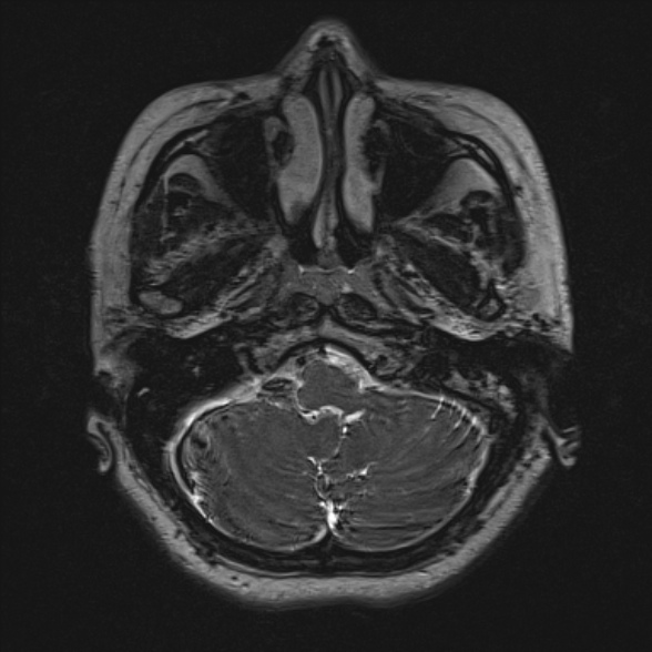 Cerebellopontine angle meningioma (Radiopaedia 53561-59591 Axial 3D volume T2 33).jpg