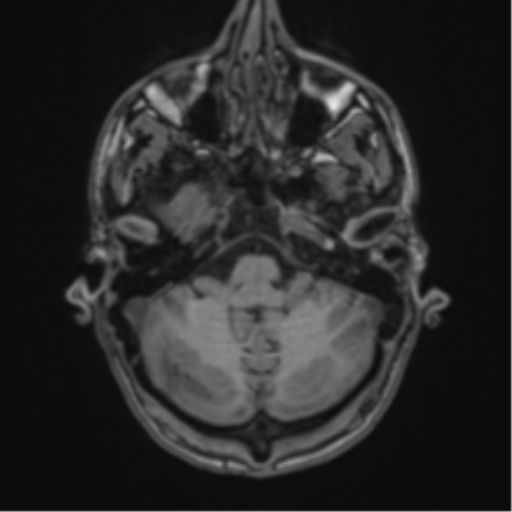 File:Cerebral abscess (Radiopaedia 60342-68009 Axial T1 7).png