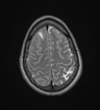 File:Cerebral abscess (Radiopaedia 60342-68009 Axial T2 30).png