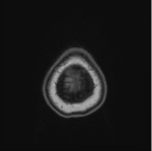Cerebral abscess from pulmonary arteriovenous malformation (Radiopaedia 86275-102291 Axial T1 72).png