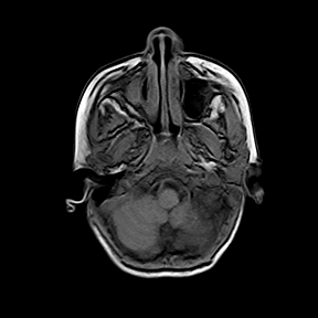 File:Cerebral abscess post cardiac surgery (Radiopaedia 27244-27420 Axial T1 3).jpg