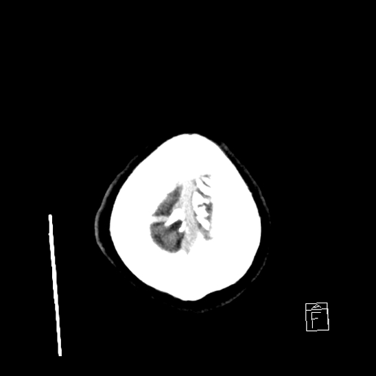 File:Cerebral abscess with ventriculitis (Radiopaedia 78965-91877 A 46).jpg