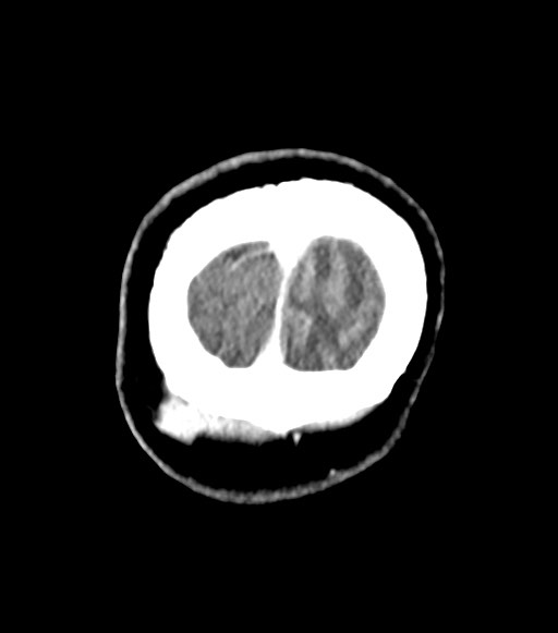 Cerebral abscesses (Radiopaedia 70458-80568 Coronal Contrast 63).jpg